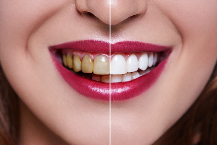 before and after comparison of teeth whitening in Fort Worth