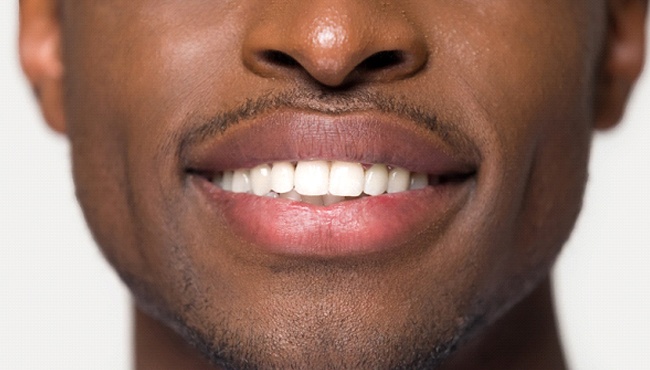 Closeup of smile after teeth whitening in Fort Worth