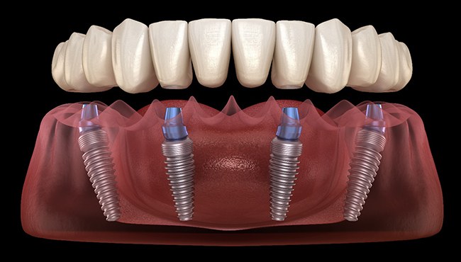 Illustration of implants for All-on-4 in Fort Worth, TX