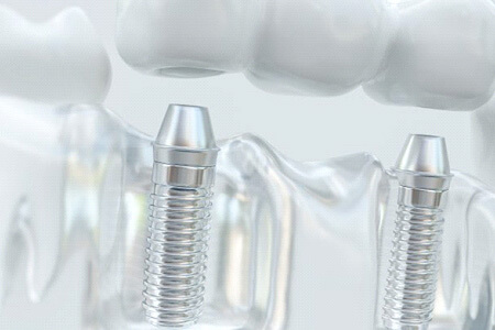 model of implant bridge