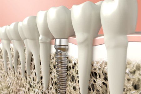 Digital illustration of a dental implant