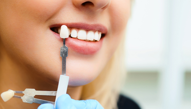 Woman's smile compared with porcelain veneer shades