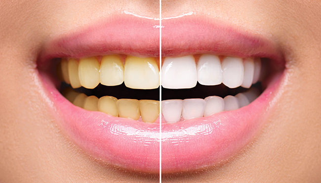 Closeup of smile before and after teeth whitening