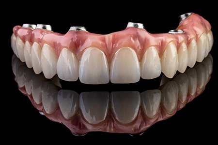 Implant dentures are more expensive but last longer and are more beneficial than traditional dentures