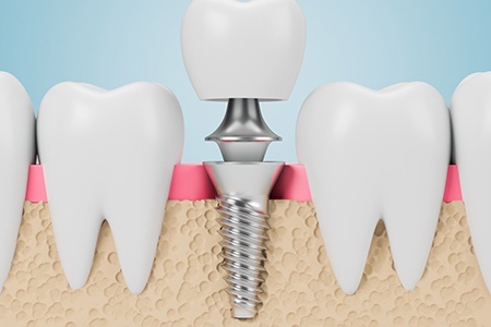 closeup of the parts of a dental implant