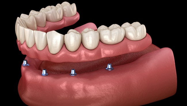 Implant dentures in Fort Worth 