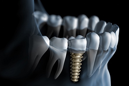 Digital illustration of a dental implant