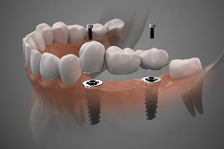 Digital illustration of a dental implant bridge