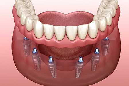 Digital illustration of an implant bridge