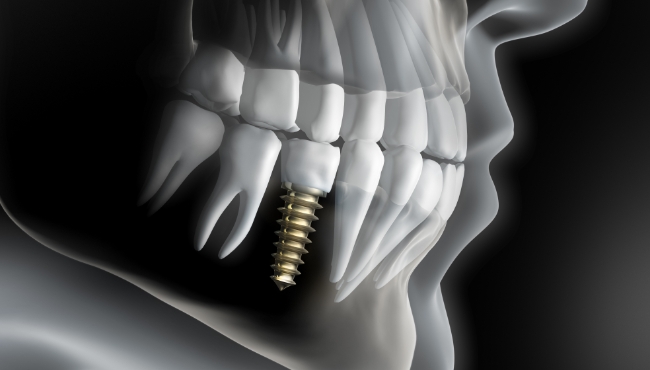 Animated dental implant supported dental crown