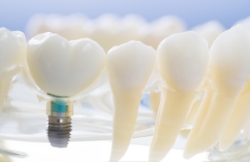 Model dental implant supported dental crown