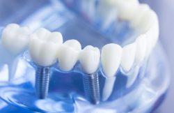 Model dental implant supported fixed brdige