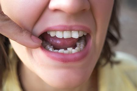 Woman with crowded teeth