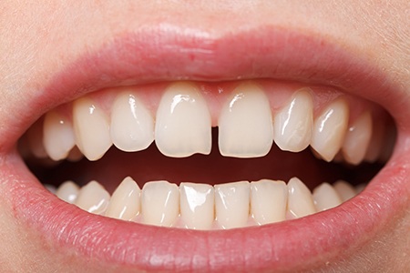 Closeup of gapped teeth