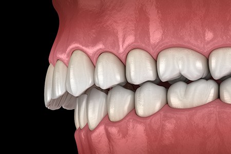 Digital illustration of an overbite