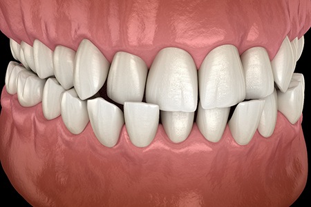 Digital illustration of an underbite