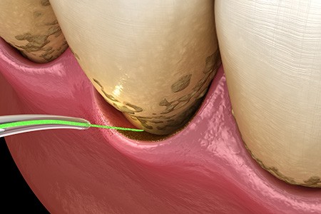 Closeup of laser periodontal treatment