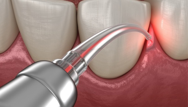 Patient holding antibiotic periodontal therapy pills and glass of water