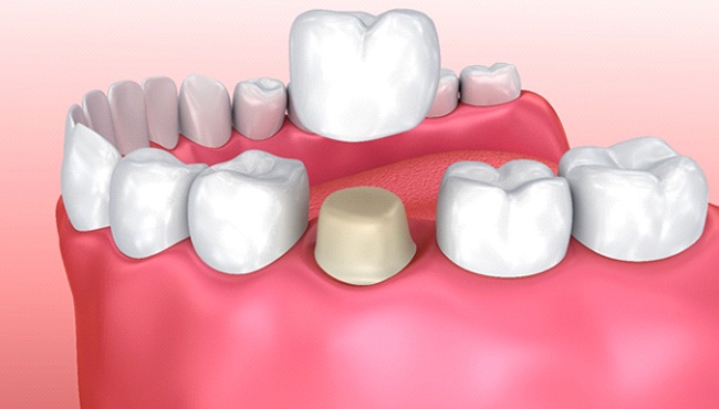 Digital image of a tooth-colored dental crown