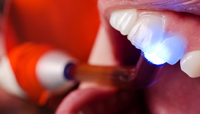 Dentist using light to harden tooth-colored filling