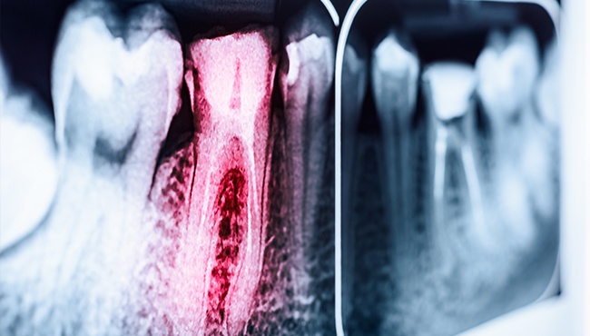 X-ray of damaged tooth before root canal therapy