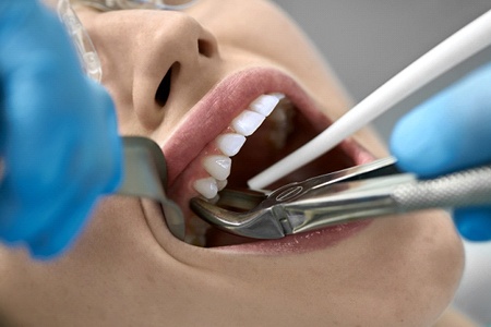 tooth extraction cost of root canal in Fort Worth