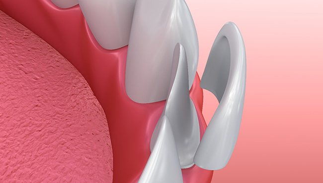 Illustration of veneer being placed on tooth