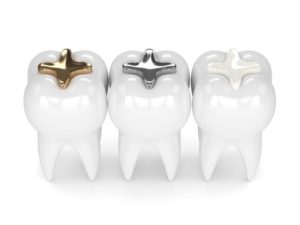 two teeth with metal fillings and one with a tooth-colored filling in Fort Worth 