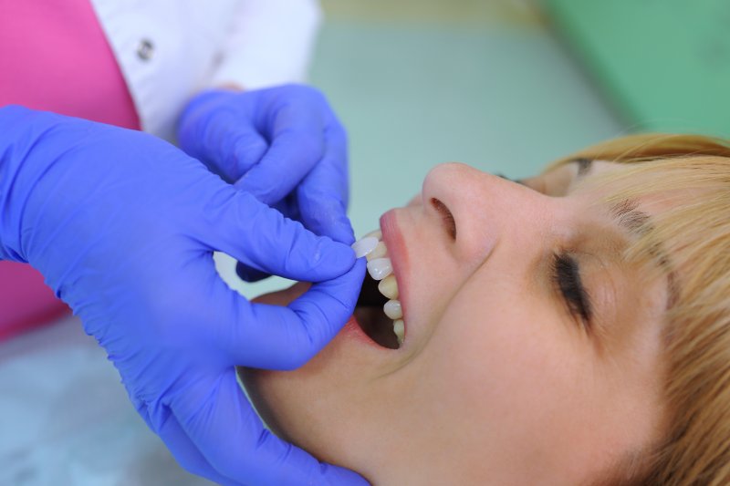 dentist placing veneers in Fort Worth