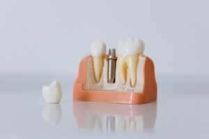 Model used for dental implants