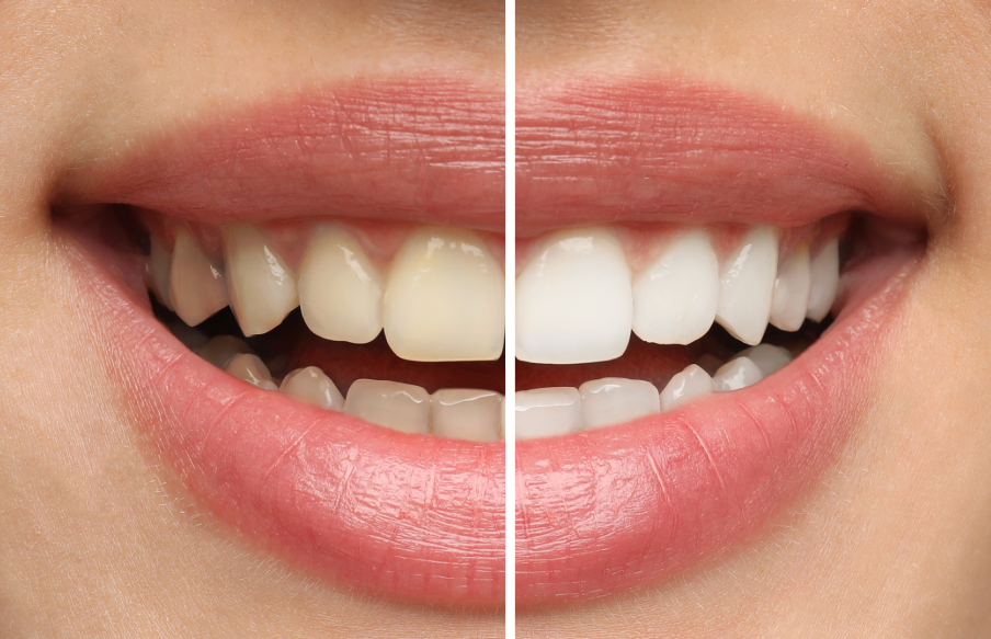 Close up of woman's smile half white, half yellow teeth